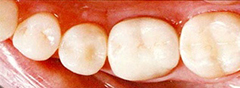 銀歯を白い歯に