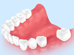歯が抜けてしまったら放置せずにおぎないましょう