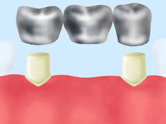 保険診療のブリッジ