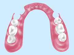 ノンクラスプデンチャー（入れ歯）