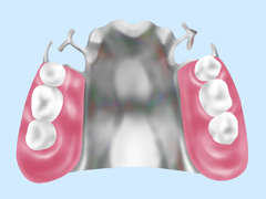 金属床義歯（入れ歯）