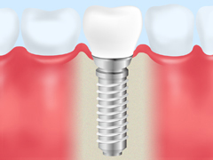 インプラントとは