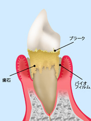 妊娠性歯周炎とは