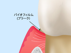 【1】歯肉炎