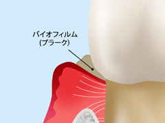 【2】軽度歯周炎