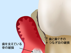 【4】重度歯周炎